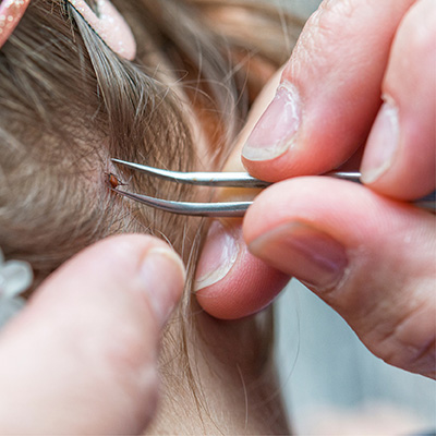Zu sehen ist Eine Zecken-Pinzette mit der an einem Hinterkopf mit dunklen Haaren eine Zecke entfernt wird