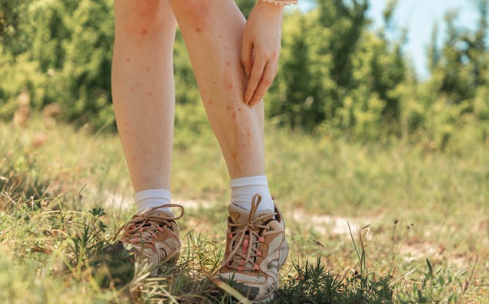 Eine Frau mit kurzer Hose steht auf einer Wiese und kratzt sich an den Beinen