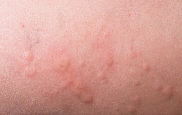 Es ist eine mit Pickeln übersähte Hautstelle zu sehen